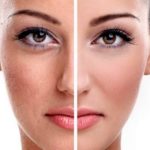 12 способов избавиться от пигментации на лице