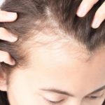 8 простых способов лечения выпадения волос на висках